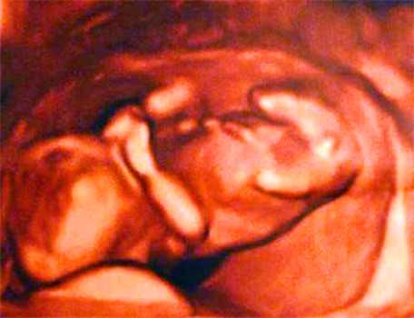 武汉试管供卵代生男孩,孕妇怀孕期间发烧对胎儿