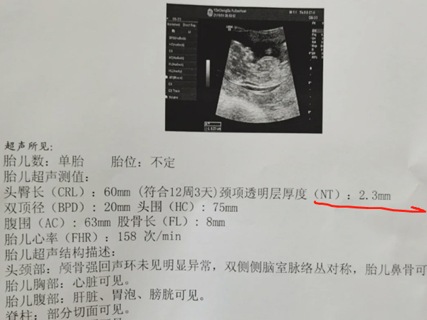 通过胎心率可以观察出试管宝宝是男孩还是女孩吗？